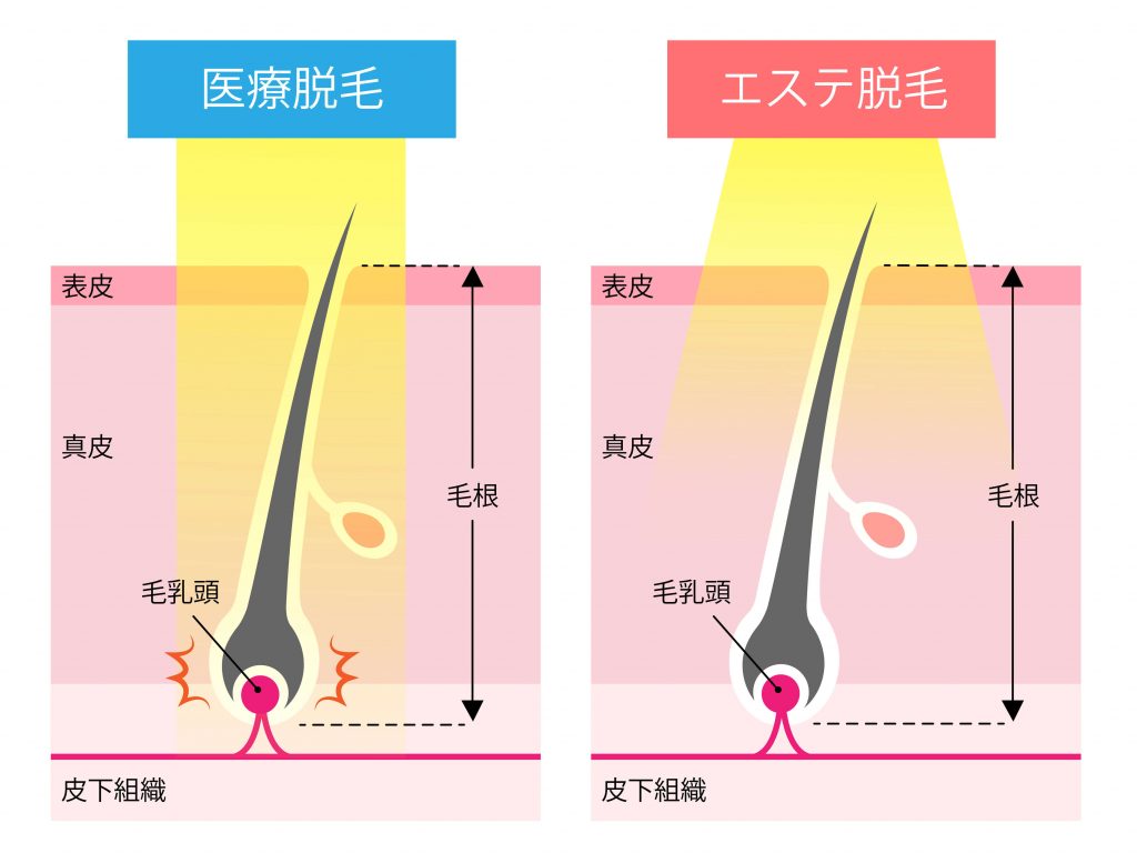 永久脱毛とは？定義や値段・費用について | 医療脱毛・医療レーザー 