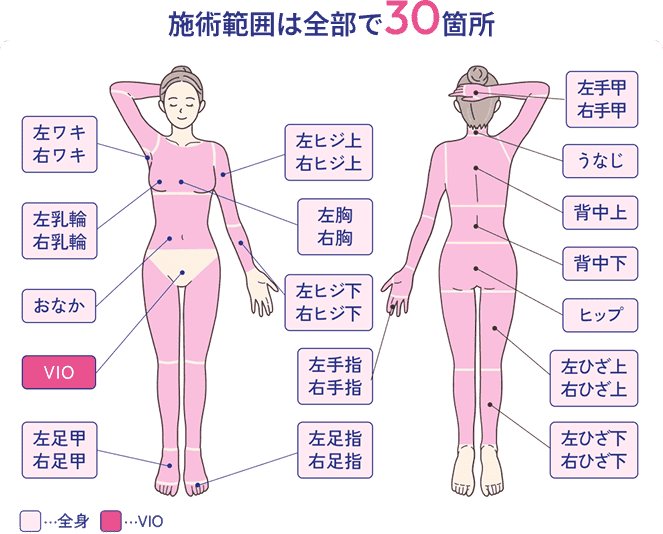 施術範囲は全部で30箇所。全身27箇所にVライン、Iライン、Oラインが追加されます。